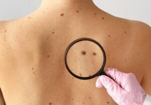 images (5) melanoma
