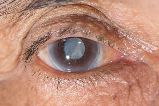 images (7) glaucoma
