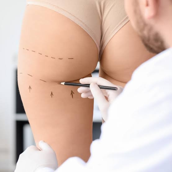 images (7) gluteoplastia