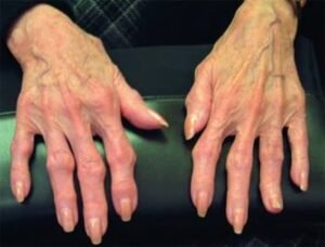 images (5) osteoartrite